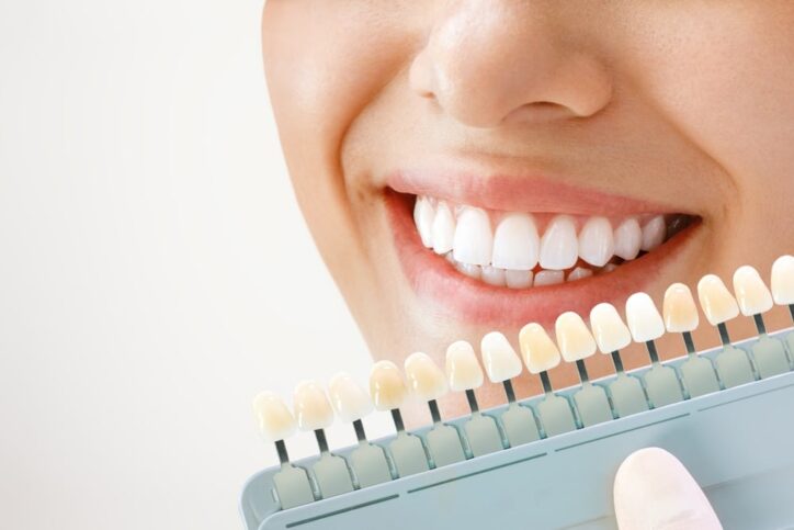 5 Techniken für eine schonende Zahnaufhellung