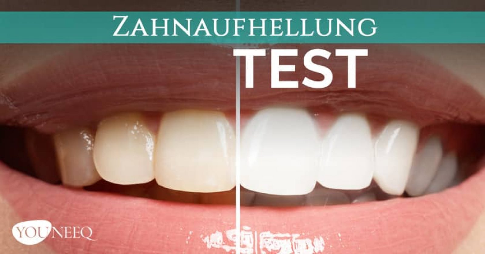 Zähne aufhellen Test